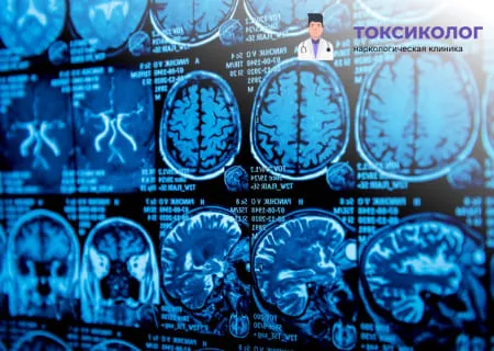 Диагностика и лечение зависимости анонимно в наркологической клинике. Снимки МРТ головного мозга при диагностике последствий употребления веществ, лечение зависимости анонимно.